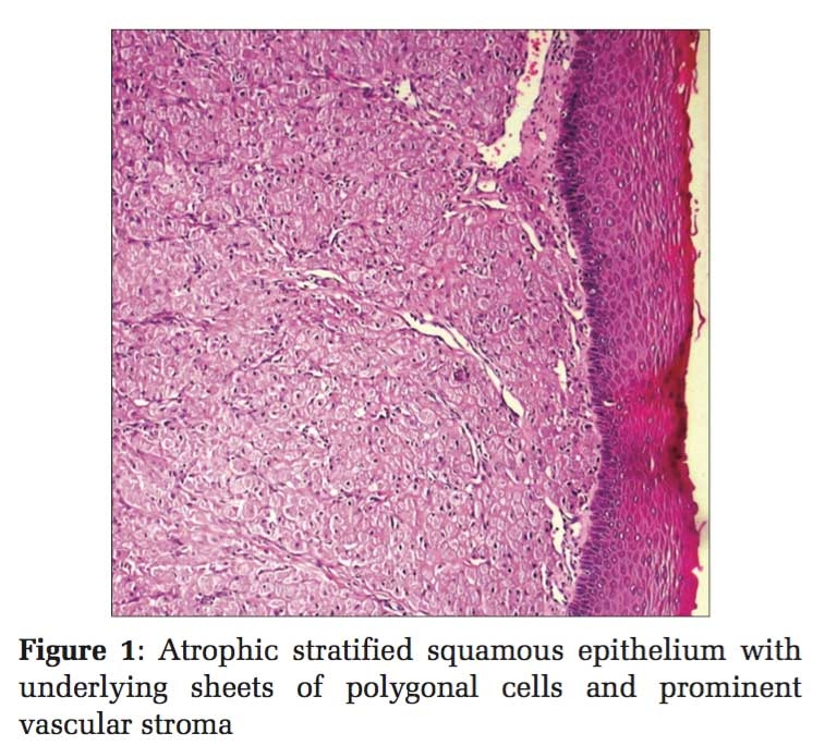 Congenital Granular Cell Epulis: A Case Report