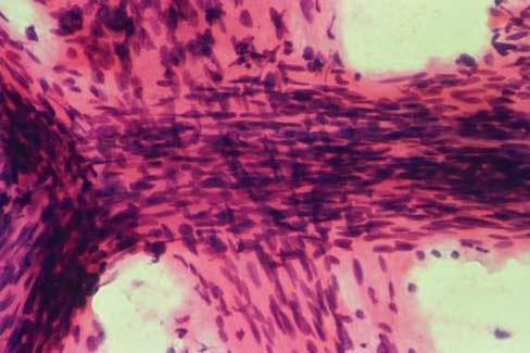 Cytodiagnosis of Scalp Lesions