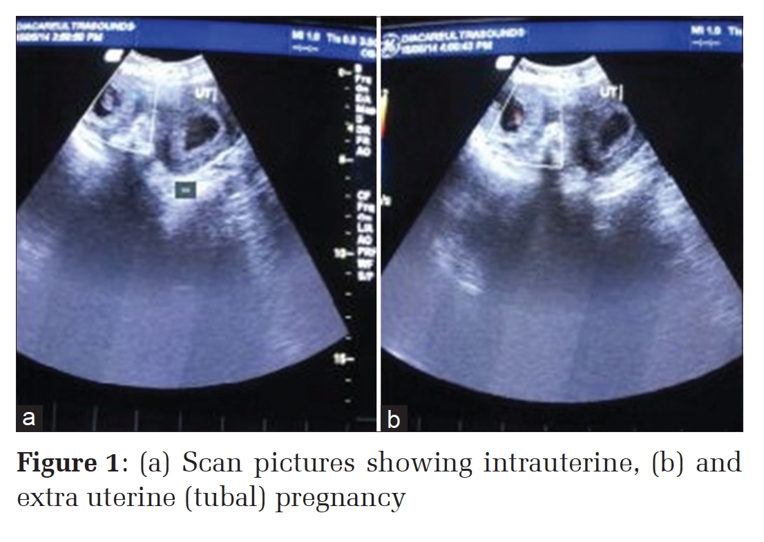 Heterotopic Pregnancy Following Spontaneous Conception: A Rare Case Report