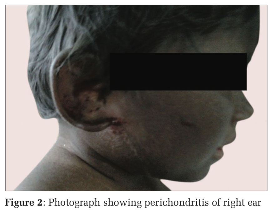 Chediak–Higashi syndrome – A Rare Case Report