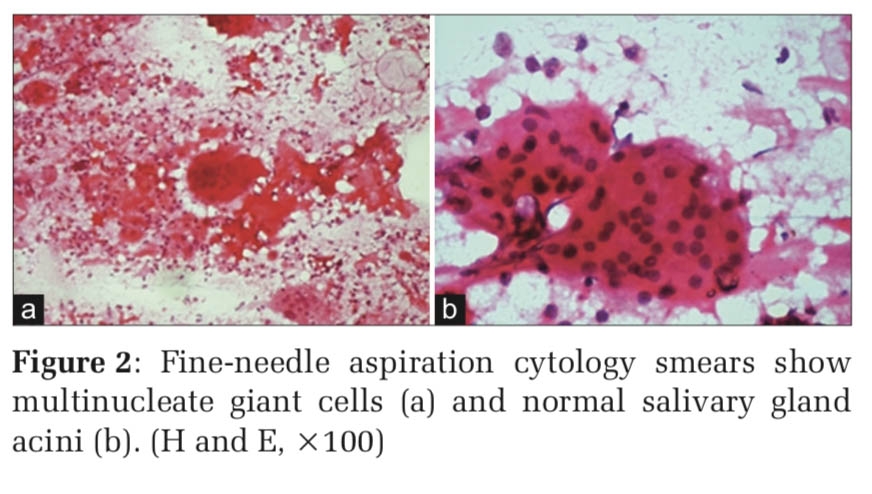 Fine Needle Aspiration Cytology of Acanthomatous Ameloblastic Carcinoma – Camouflaging as a Parotid Tumor
