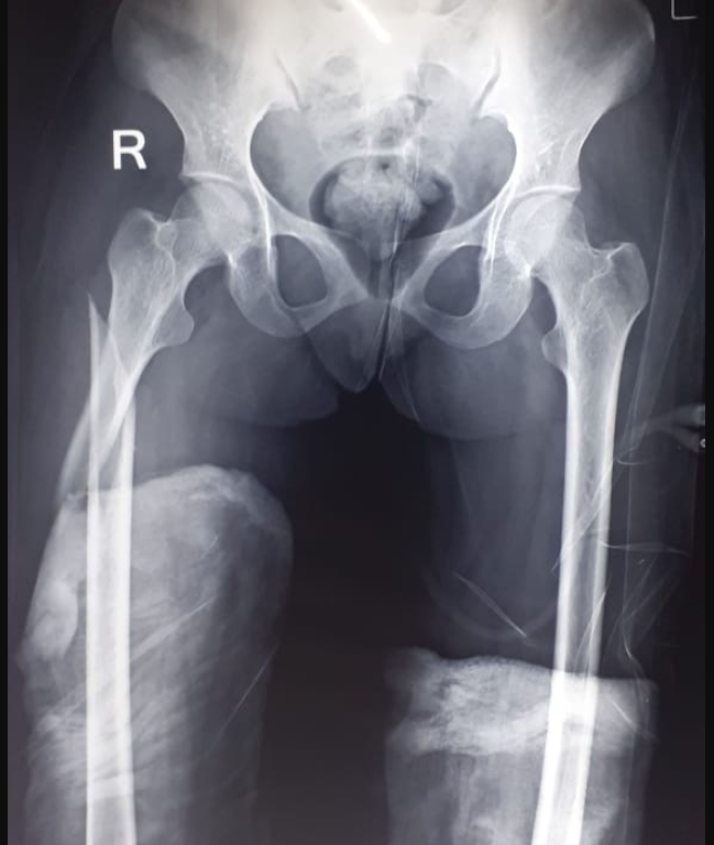 Management of Bilateral Lower Limb Fractures in a Third Trimester Gravida: Case Report and Review
