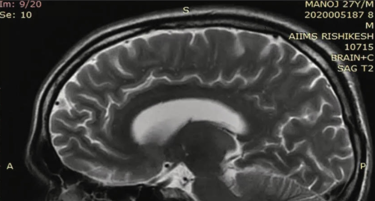 Clinico-Radiological Dissociation in a Patient with Hypoxic Ischemic Encephalopathy