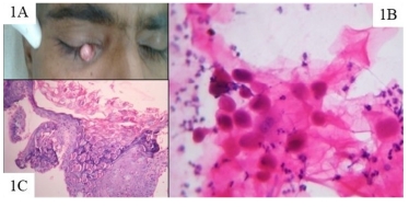Role of Aspiration Cytology in Intraocular and Periorbital Adnexal Lesions