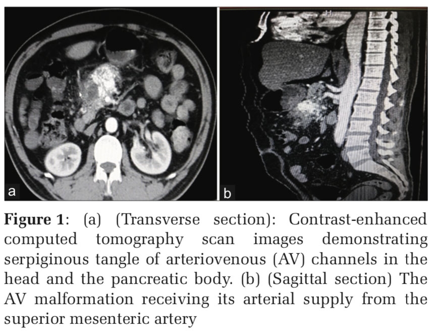 Pancreatic Arteriovenous Malformation: A Case Report and Review of Literature