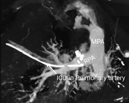 Iatrogenic Insertion of Chest Tube inside the Right Pulmonary Artery: Unique, Unheard Complication, and Management