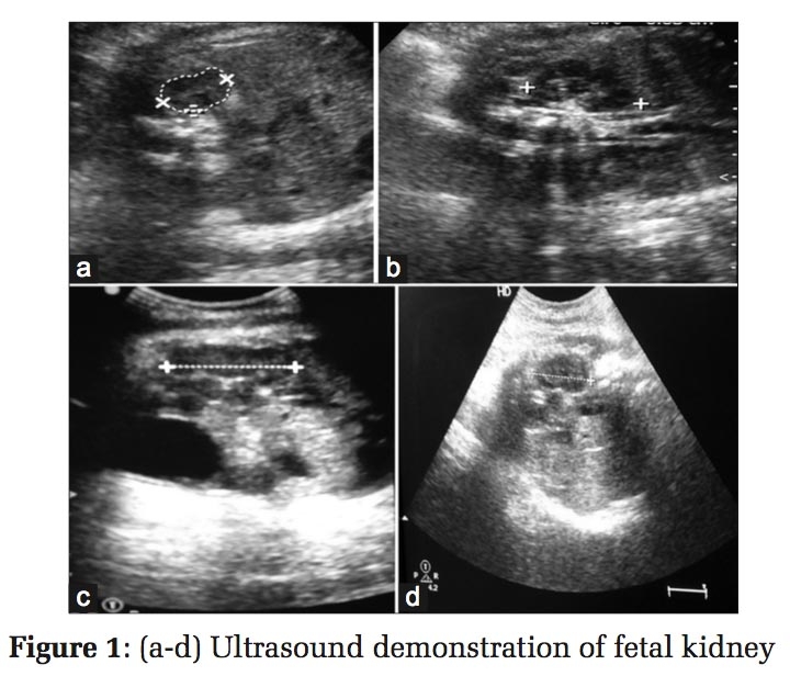 Correlation of Gestational Age with Fetal Renal Length in Third Trimester Pregnancy