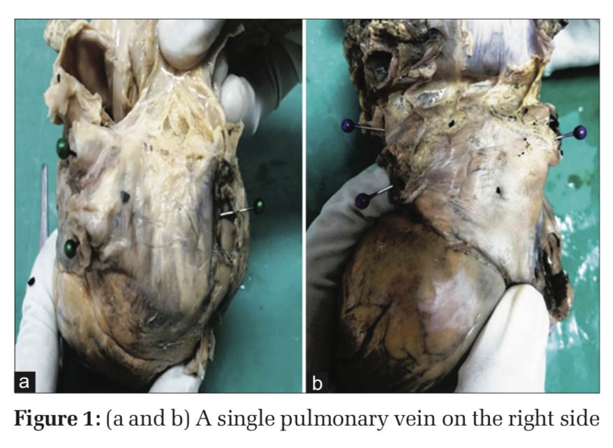 Anatomic Study of Number of Pulmonary Veins Draining into the Left Atrium and Their Variations