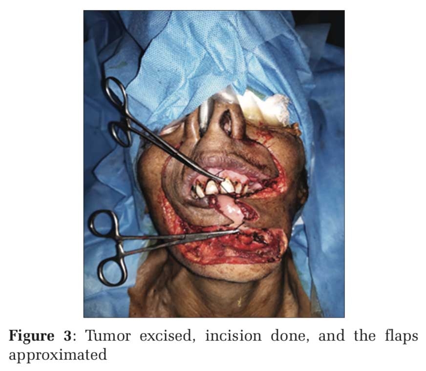 Karapandzic and Bernard Burrow Webster Flap Amalgamation in Reconstruction of Near-Total Defect of the Lower Lip