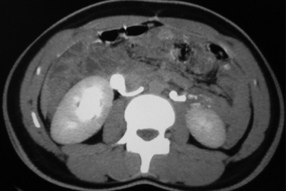 Retrocaval Ureter: An Uncommon Cause of Hydroureteronephrosis