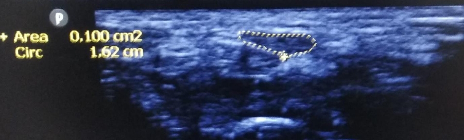 Nerve Ultrasound Findings in Carpal Tunnel Syndrome and its Correlation with Clinical and Electrophysiological Data