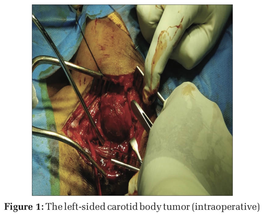 Carotid Body Tumor Resection – A Case Report