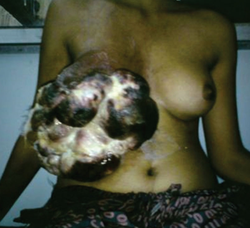 Primary Sarcoma of Breast in a 19-year-old Female: A Rare Entity