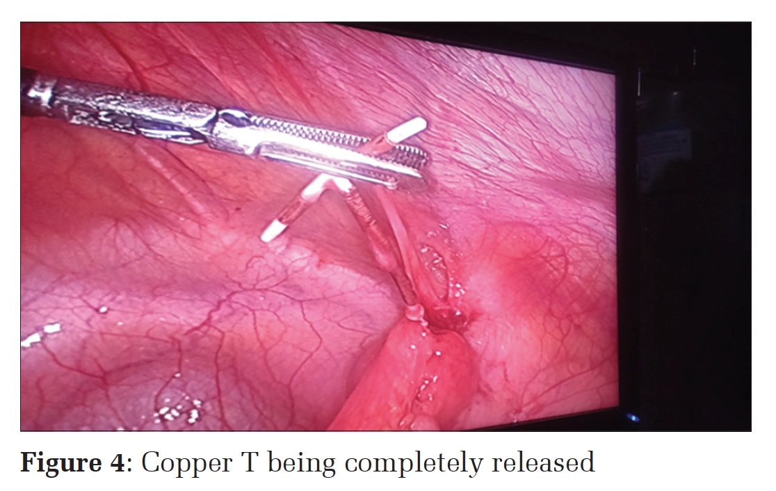 A Case Report of Successful Retrieval of Missing Copper T by Laparoscopic Approach