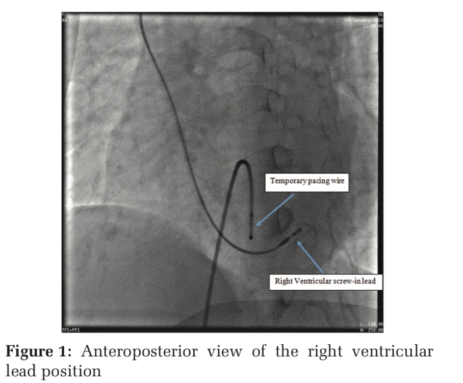 Transvenous Low Septal Permanent Pacing for a Patient with Ebstein’s Anomaly – A Case Report