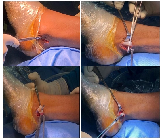 Assessment of Functional Outcome and Donor Site Morbidity in Anterior Cruciate Ligament Reconstruction Using Peroneus Longus Autograft