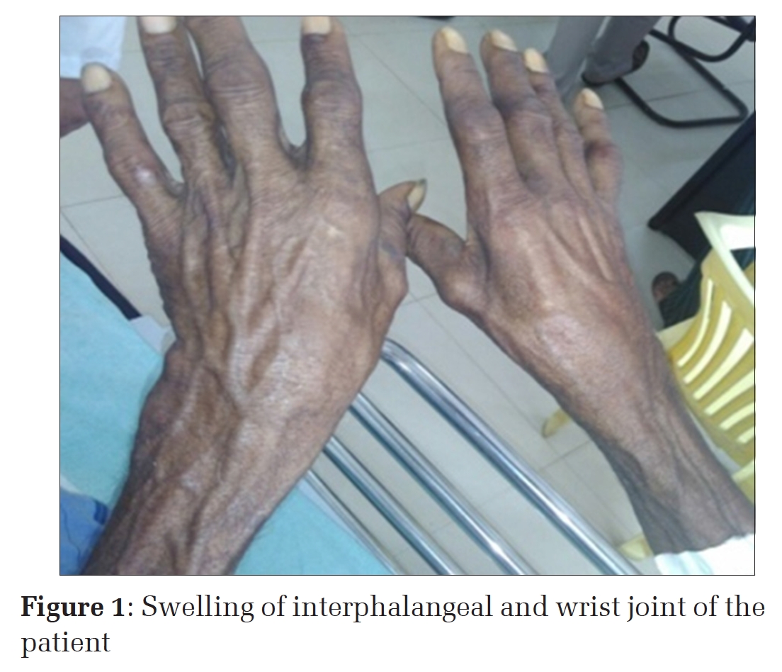 Disseminated Cysticercosis – Manifested with an Unusual Symptom