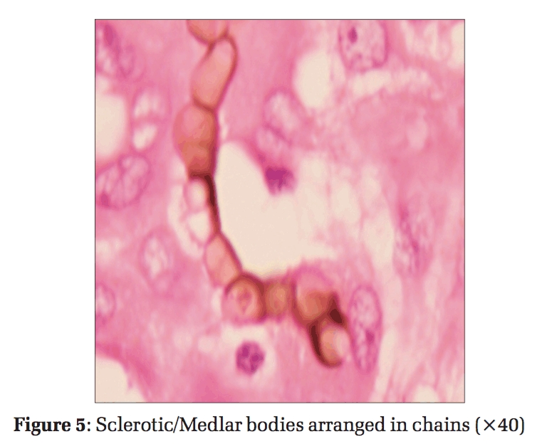 Cutaneous Chromoblastomycosis: A Case Report