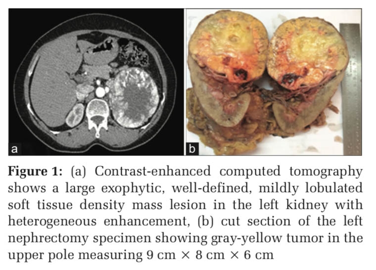 A Rare Incidental Finding of Liesegang Rings in a Case of Clear Cell Renal Cell Carcinoma