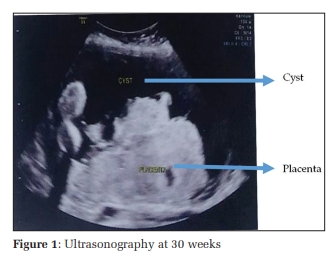 Placental Cyst-a Rare Cause of Fetal Growth Restriction - A Case Report