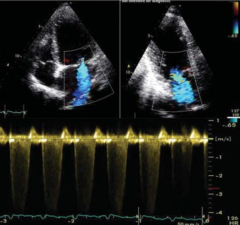 An Unusual Case of Refractory Angina