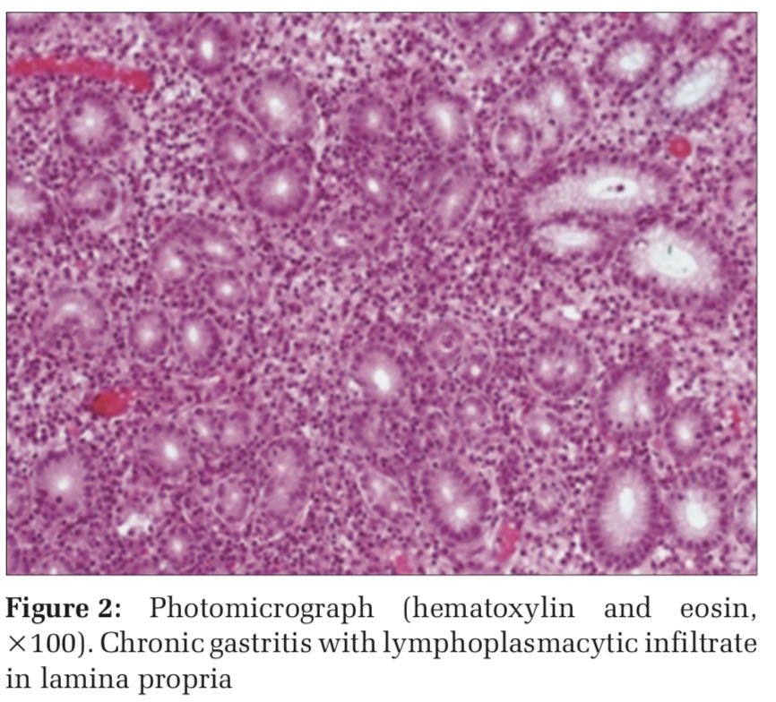 Histopathological Patterns of Gastric Mucosal Biopsies in Dyspepsia – A Study of 550 Cases