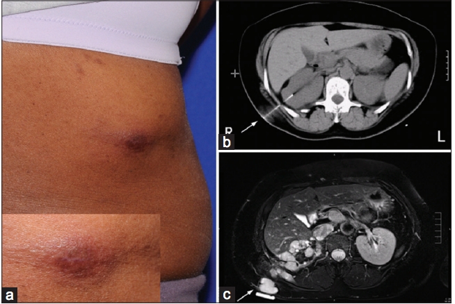 Needle-track Tumor Seeding Consequent to Renal Biopsy