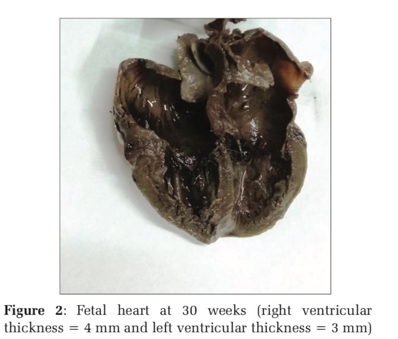 Assessment of Fetal Left and Right Ventricular Thickness and Its Comparison with Other Parameters: A Study of 20 Cases