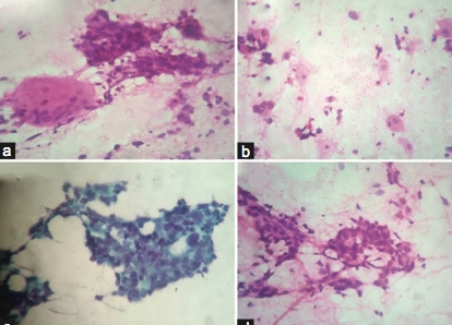 Sebaceous Carcinoma of Lid: A Great Clinical Mimic