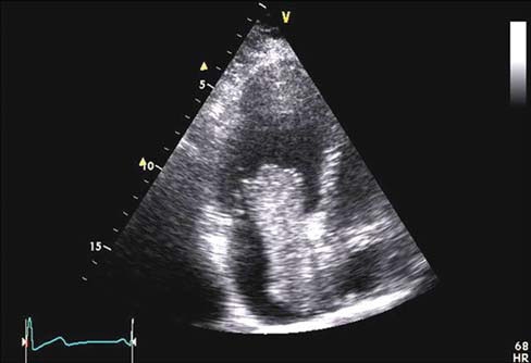 A Large Atrial Myxoma in a Patient Presenting with Paroxysmal Atrial Fibrillation: A Case Report