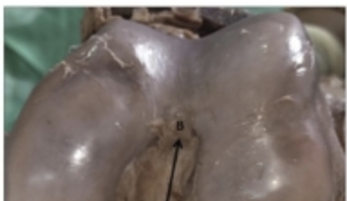 Association between Intercondylar Notch Dimensions and Morphometry of Anterior Cruciate Ligament – A Cadaveric Study