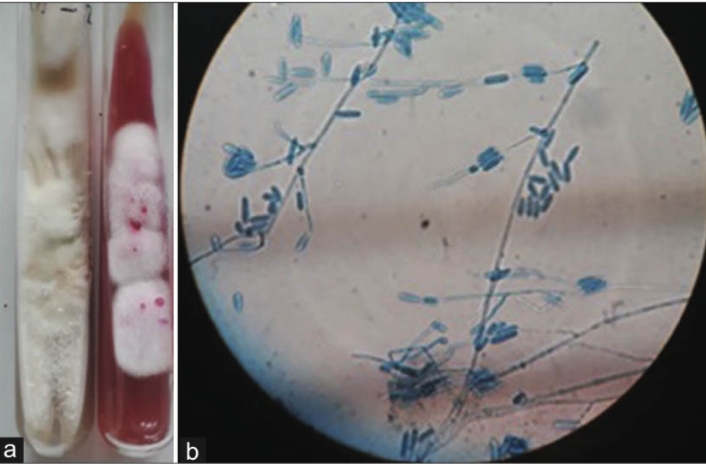 Dual Dermatophyte Infections in a Young Patient with Onychomycosis from Coastal Karnataka: A Rare Experience
