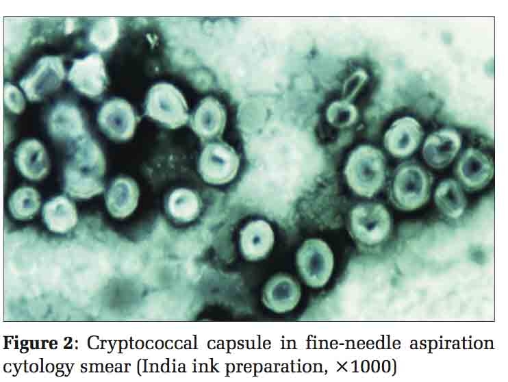 Cryptococcal Lymphadenitis in Human Immunodeficiency Virus-Infected Patient - Diagnosis by Fine-Needle Aspiration Cytology