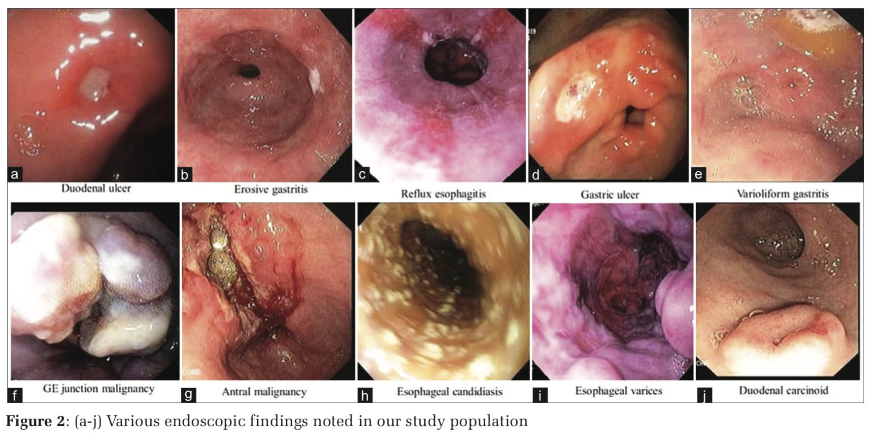 Clinical and Endoscopic Profile of Patients with Uninvestigated Dyspepsia: Experience from a Single Center