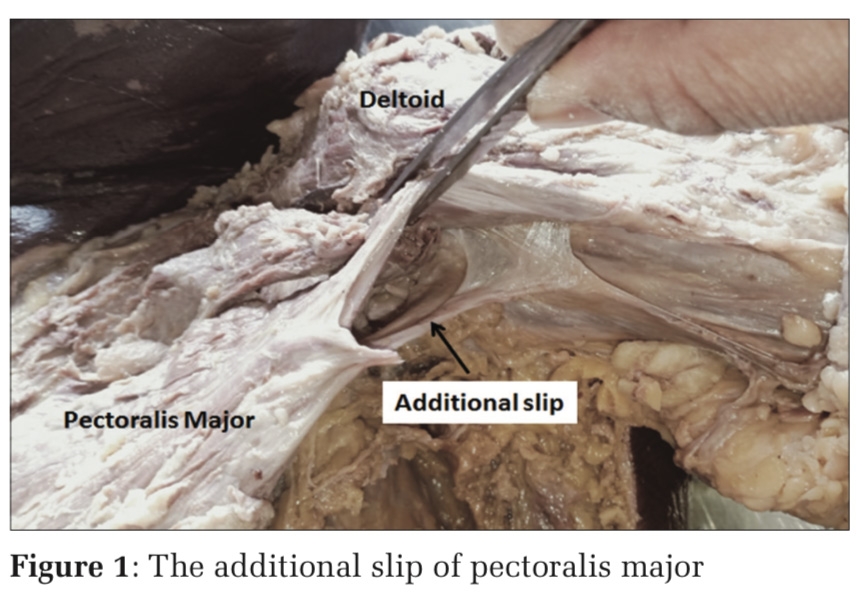 A Case Report of Additional Slip of Pectoralis Major – Pectorotubero Fascialis Muscle
