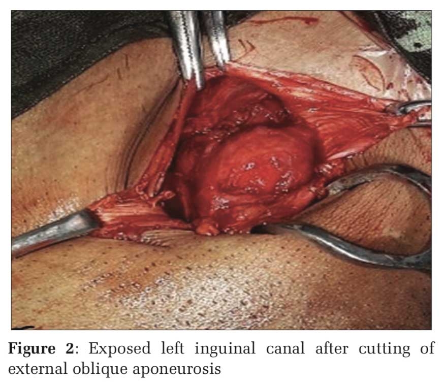 Femoral Hernia: A Review of the Clinical Anatomy and Surgical