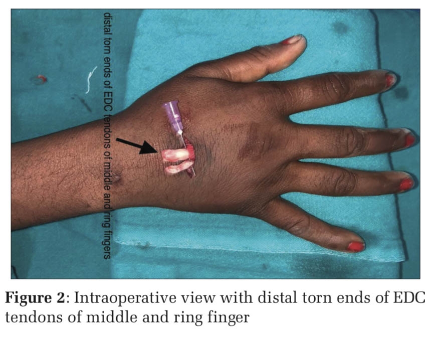 An Unusual Mode of Extensor Tendon Injury – A Case Report