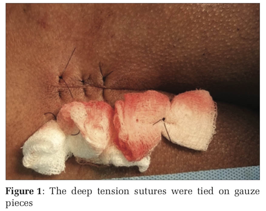 Role of Deep Tension Sutures in Closing the Defect Following Excision of Sacrococcygeal Pilonidal Sinus – A Case Series