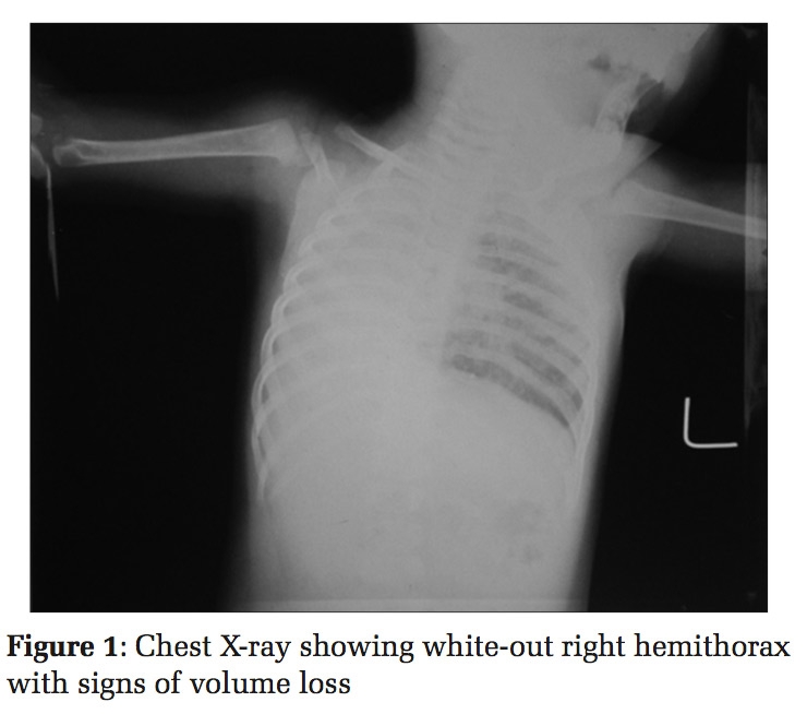 Right Lung Agenesis with Dextrocardia: A Case Mismanaged as Pneumonia