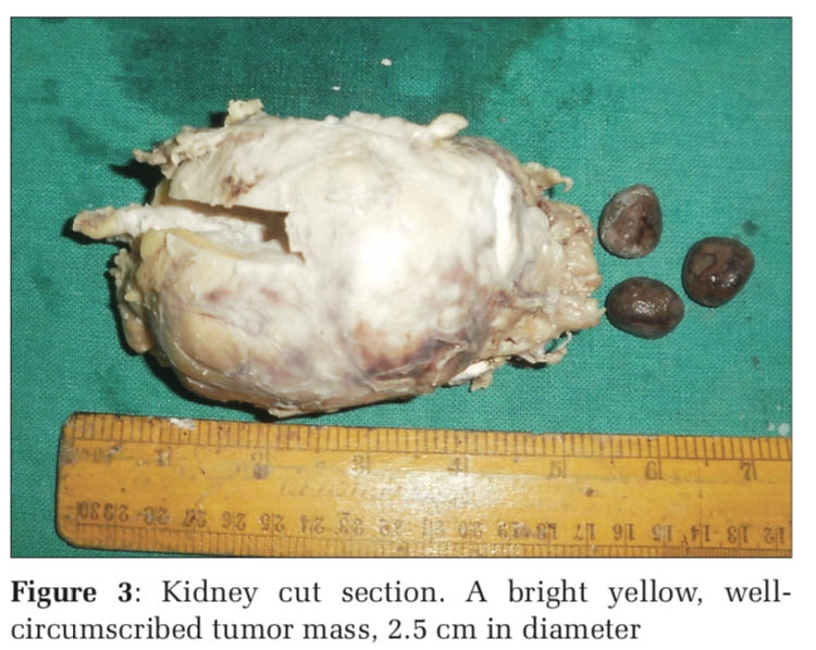 Incidentally Detected Renal Neoplasms in Nephrectomy and Postmortem Specimens, with A Review of Literature