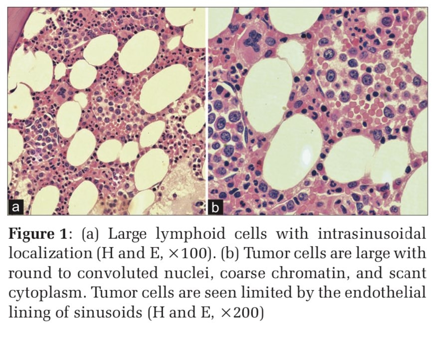 Intravascular Large B-cell Lymphoma – Morphological Diagnosis in the Molecular Era