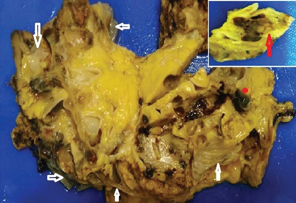 Acquired Cystic Kidney Disease Associated Renal Cell Carcinoma: A Case Report