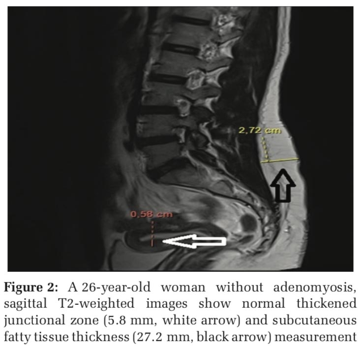 Adenomyosis and Subcutaneous Fatty Tissue Thickness Relationship
