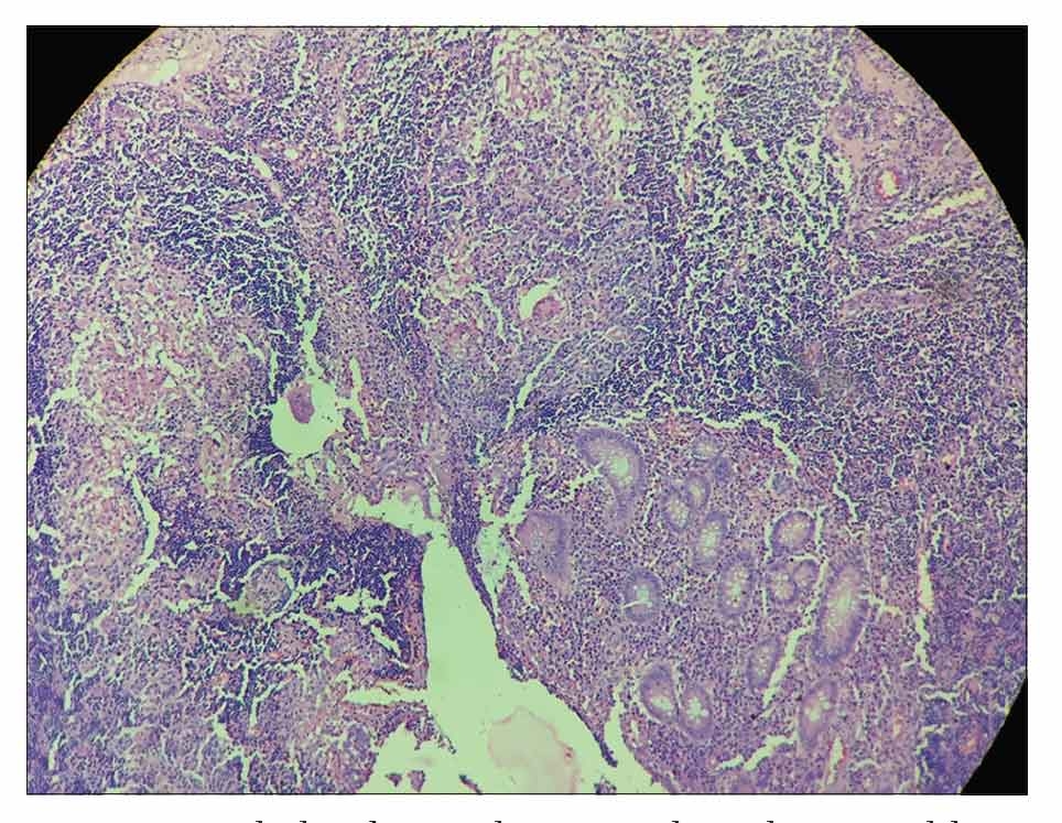 Isolated Tubercular Inflammation of the Appendix: A Case Report