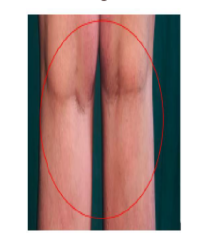 Case Report: Etoricoxib Induced Acute Generalized Exanthematous Pustulosis