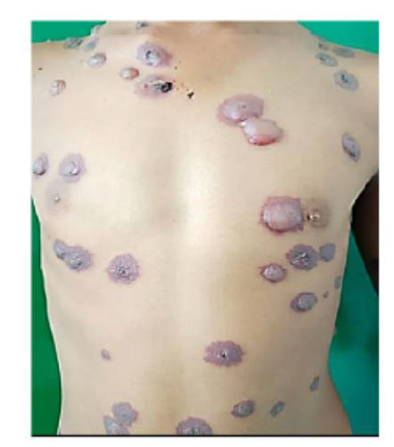 A Rare ADR of Co-amoxiclav induced Stevens-Johnson Syndrome in a Young Patient: A Case Report