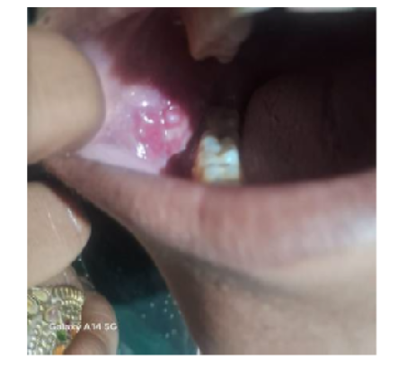 Beyond Herpes: A Case of Oral-Dominant Pemphigus Vulgaris Initially Misdiagnosed as Herpetic Stomatitis