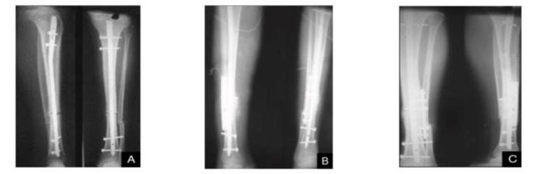 Effect of Denosumab Injection in Early Union and Consolidation o f Callus in Aseptic Tibial Shaft Non-union